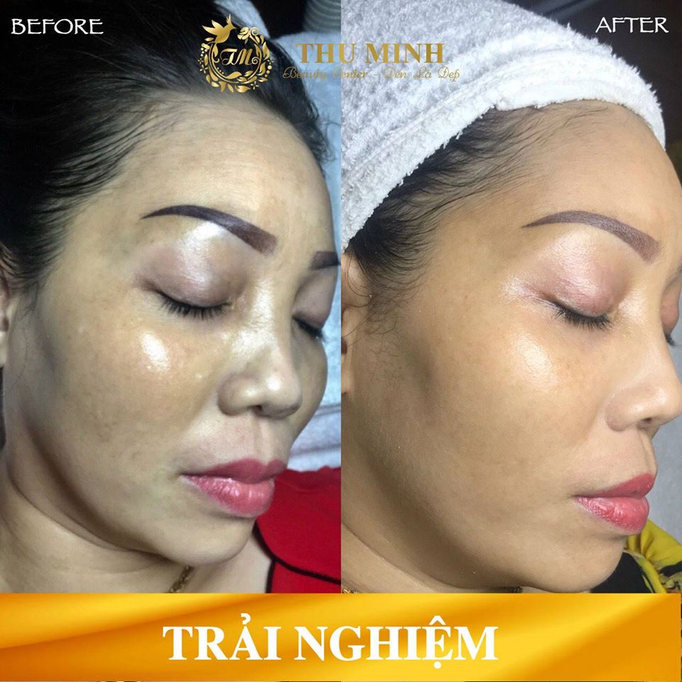 [Cập nhật 2020] Tiêm căng bóng da mặt giá bao nhiêu